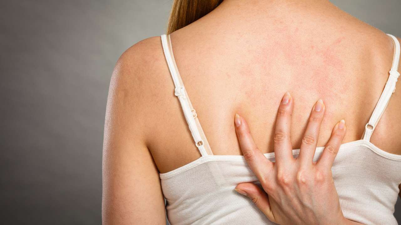 Close up rear view of woman scratching her inflamed back acne between her shoulder blades on a gray background.