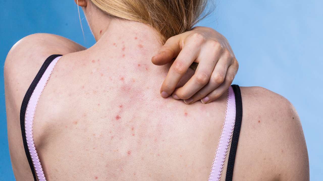 Close up rear view of woman reaching over her shoulder to scratch the inflamed back acne between her shoulder blades.