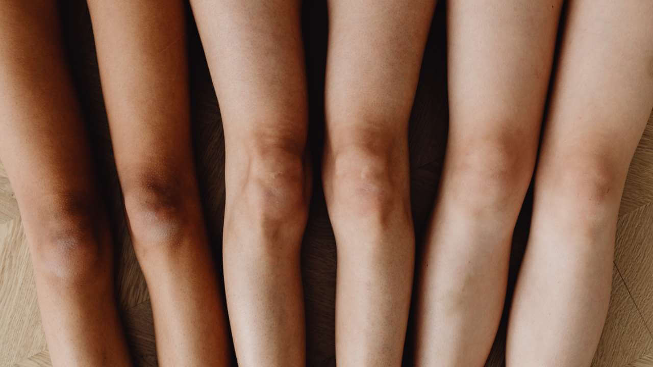 Closeup of 3 sets of women’s legs with dark areas of skin on the knees caused by skin damage from sun exposure.