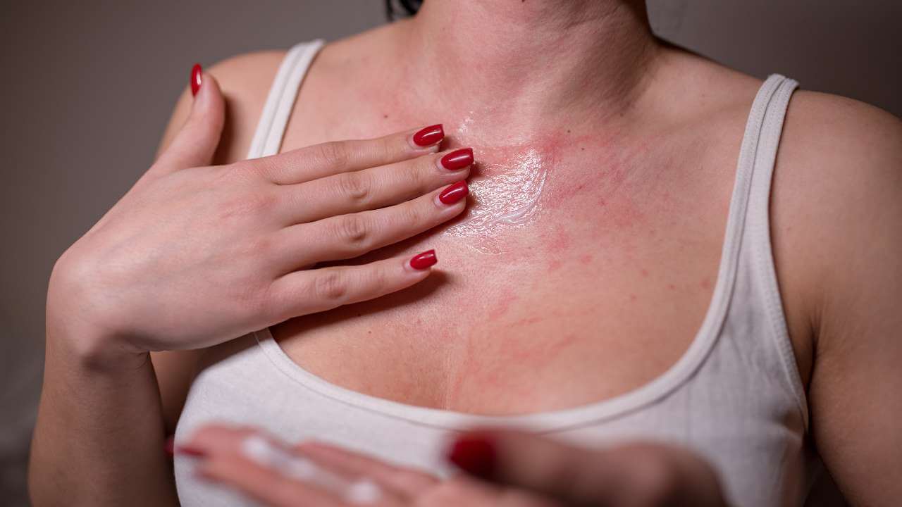 A woman rubbing benzoyl peroxide cream on her chest covered in red bumps as an acne treatment to get rid of chest acne.