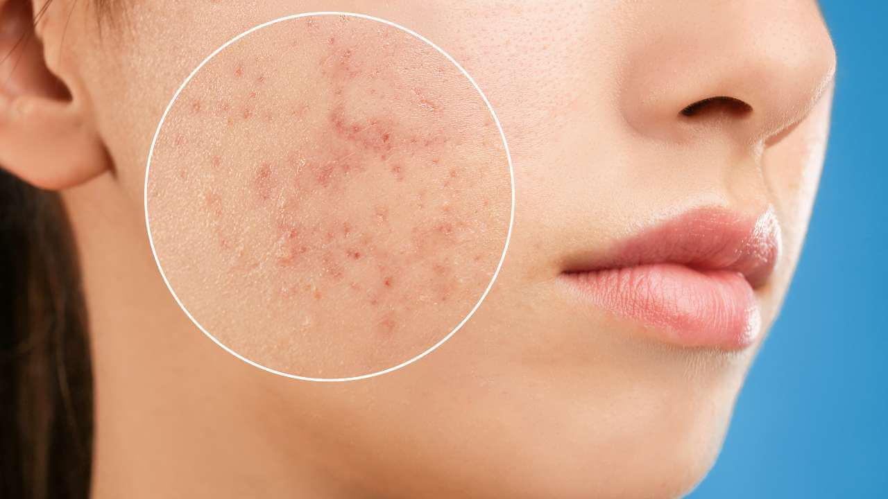 Closeup, right-sided view of acne scarring on a woman’s cheek with a white circle drawn around the area on a blue background.