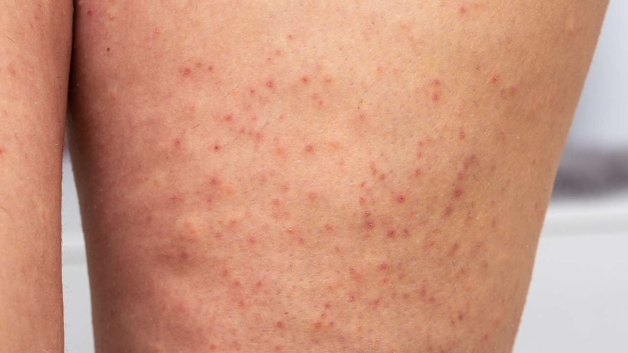 Little dark spots on a woman’s thigh that look like strawberry seeds which require treatment from a trained professional.