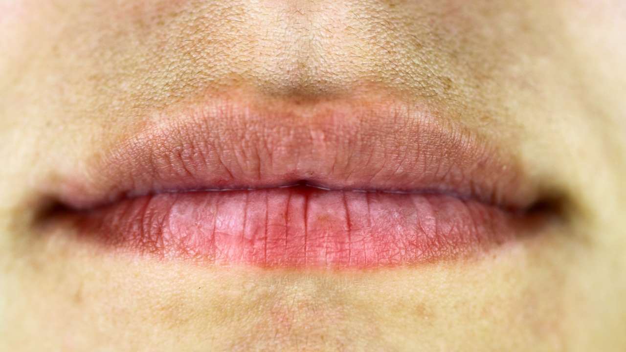 Closeup of skin darkening and sun spots caused by hyperpigmentation around the mouth.