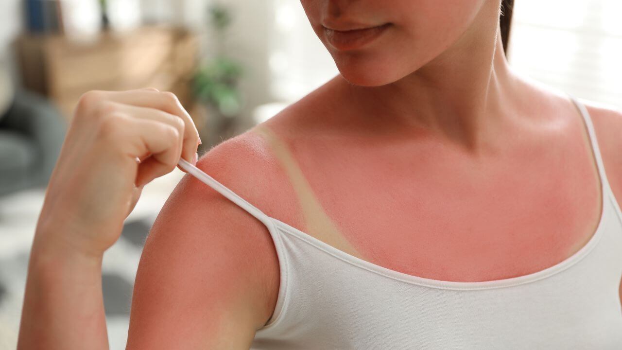 Woman pulling the strap of her white tank top to expose sun damage from a severe sunburn on her chest and shoulders.