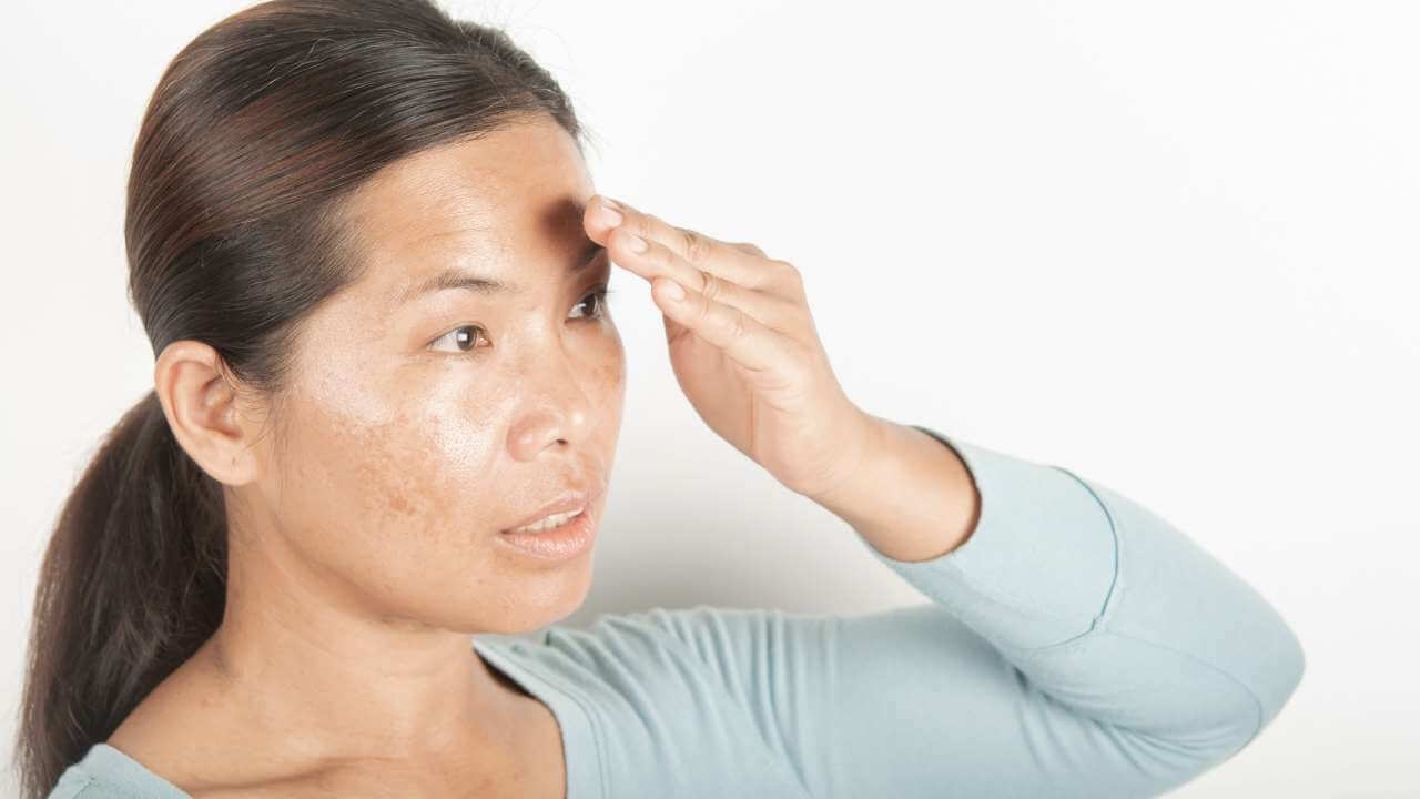 Asian woman shields dark spots on her face with her hand to prevent further sun damage and visible signs of aging.