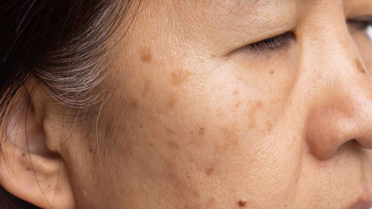 Visible signs of aging on an Asian woman’s face causing brown spots and uneven skin tone from sun damage.