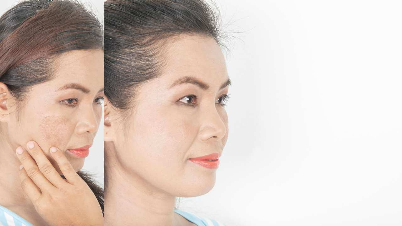 Asian woman with freckle like spots before using skin care products on her face, and even skin tone after melasma treatments.