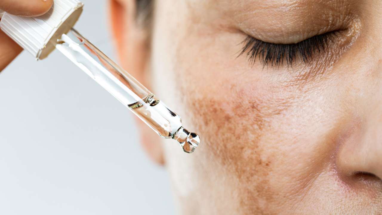 Closeup of a woman using kojic acid serum on dark patches and freckle like spots to improve melasma symptoms on her face.