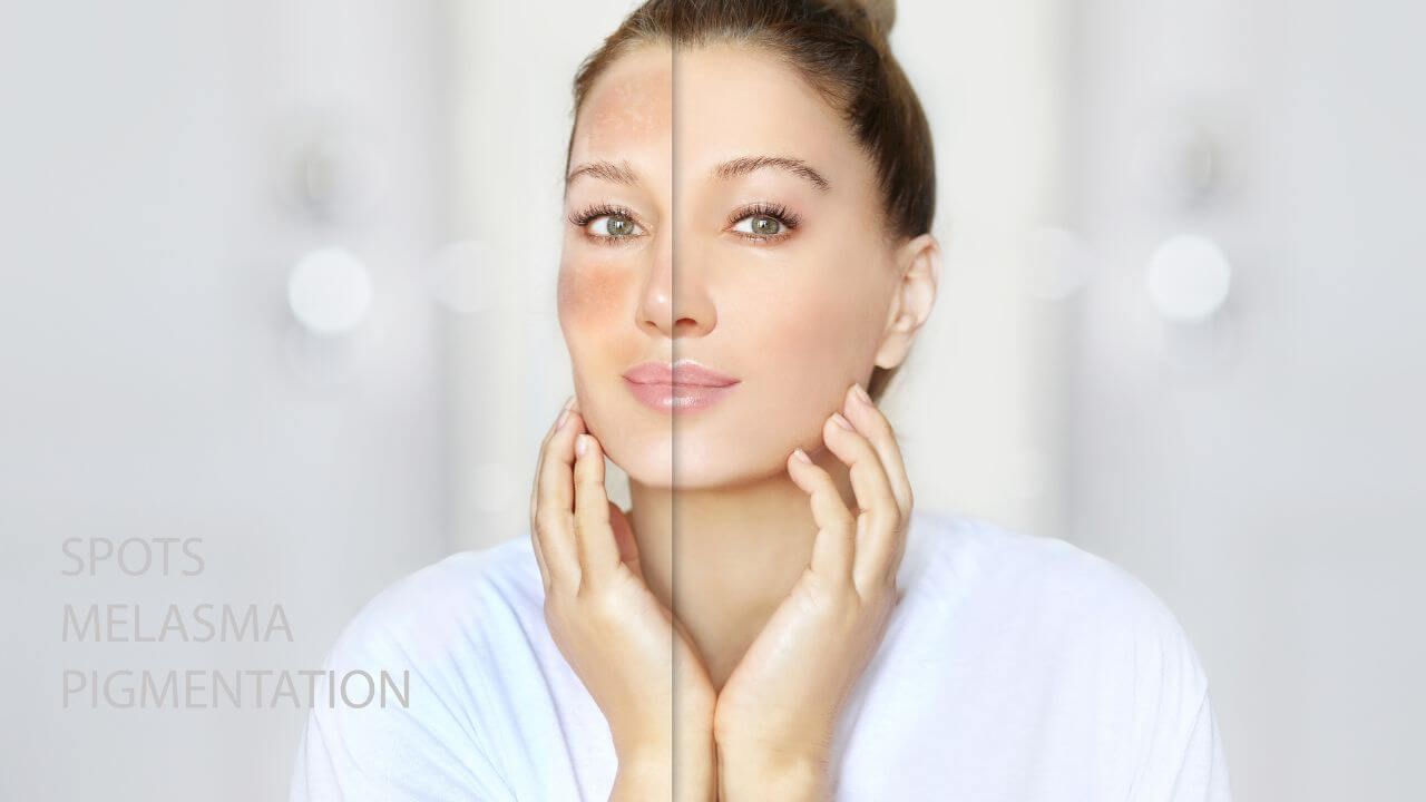 Dark areas on a woman’s face before using a body wash to reduce hyperpigmentation, and after revealing smoother skin.