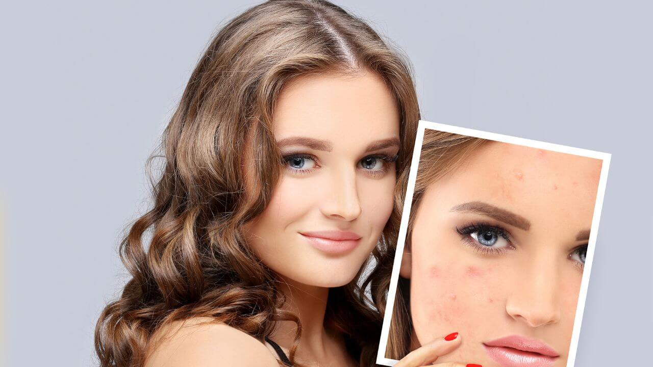 Close up of a smiling, beautiful woman holding a before picture of herself with multiple acne blemishes all over her face