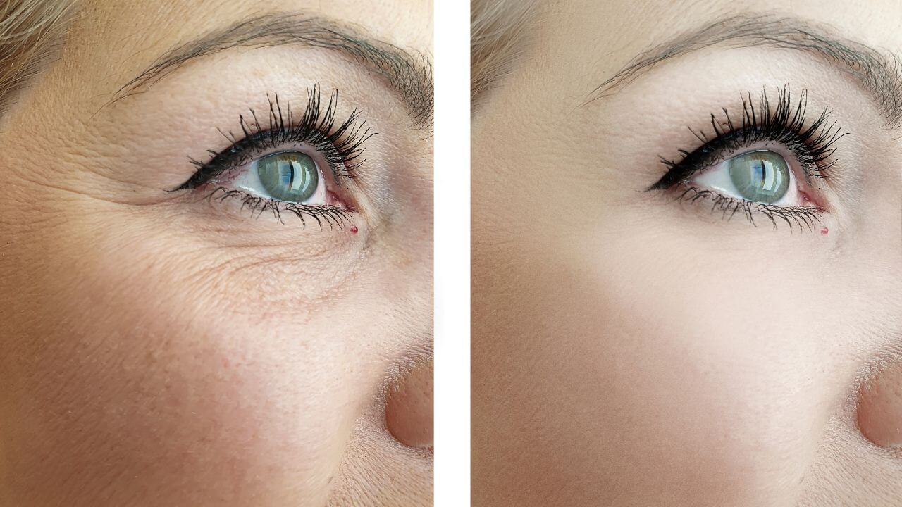 Fine lines and dynamic wrinkles about a woman’s right eye before various treatment options and a smoother appearance after. 