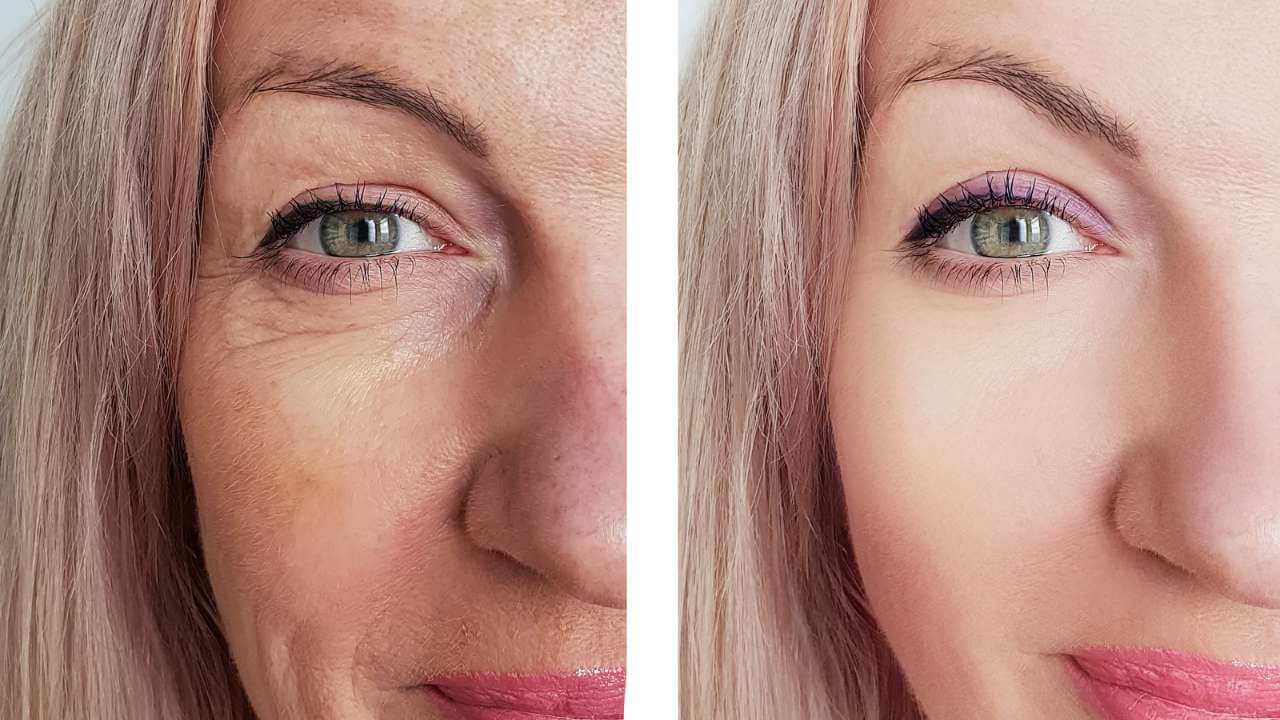 Woman’s face before treatment for post inflammatory hyperpigmentation and even skin color after successful treatment.
